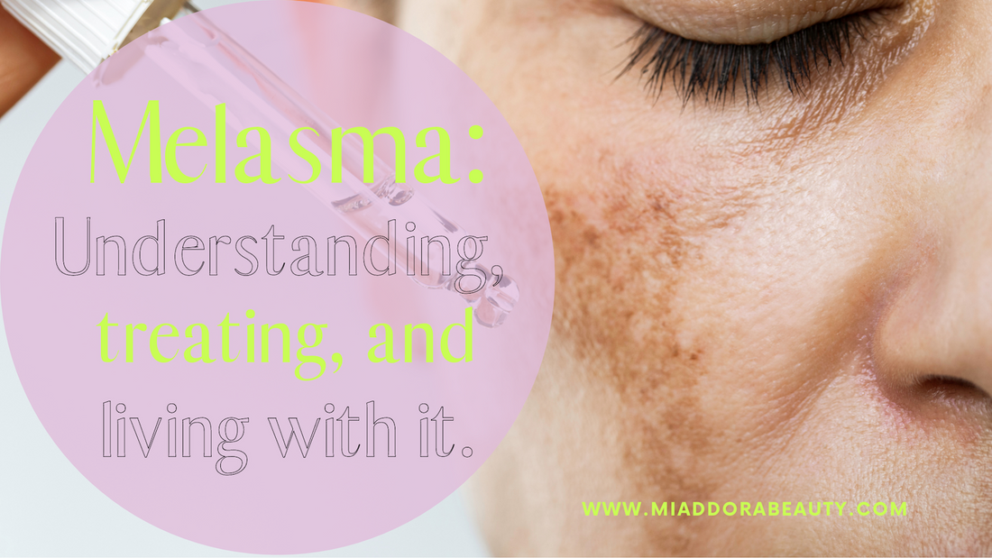 Melasma: What Is It, How to Treat It, and the Perfect Skincare Routine!